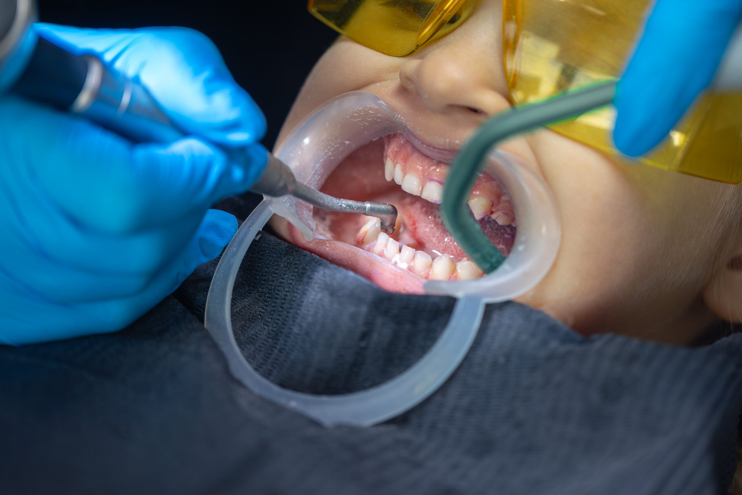 Child receiving dental cavity filling treatment Pediatric dentist treating tooth decay in a child Close-up of child’s mouth during dental check-up "Kids' dental care – cavity treatment in progress Young patient undergoing painless cavity filling