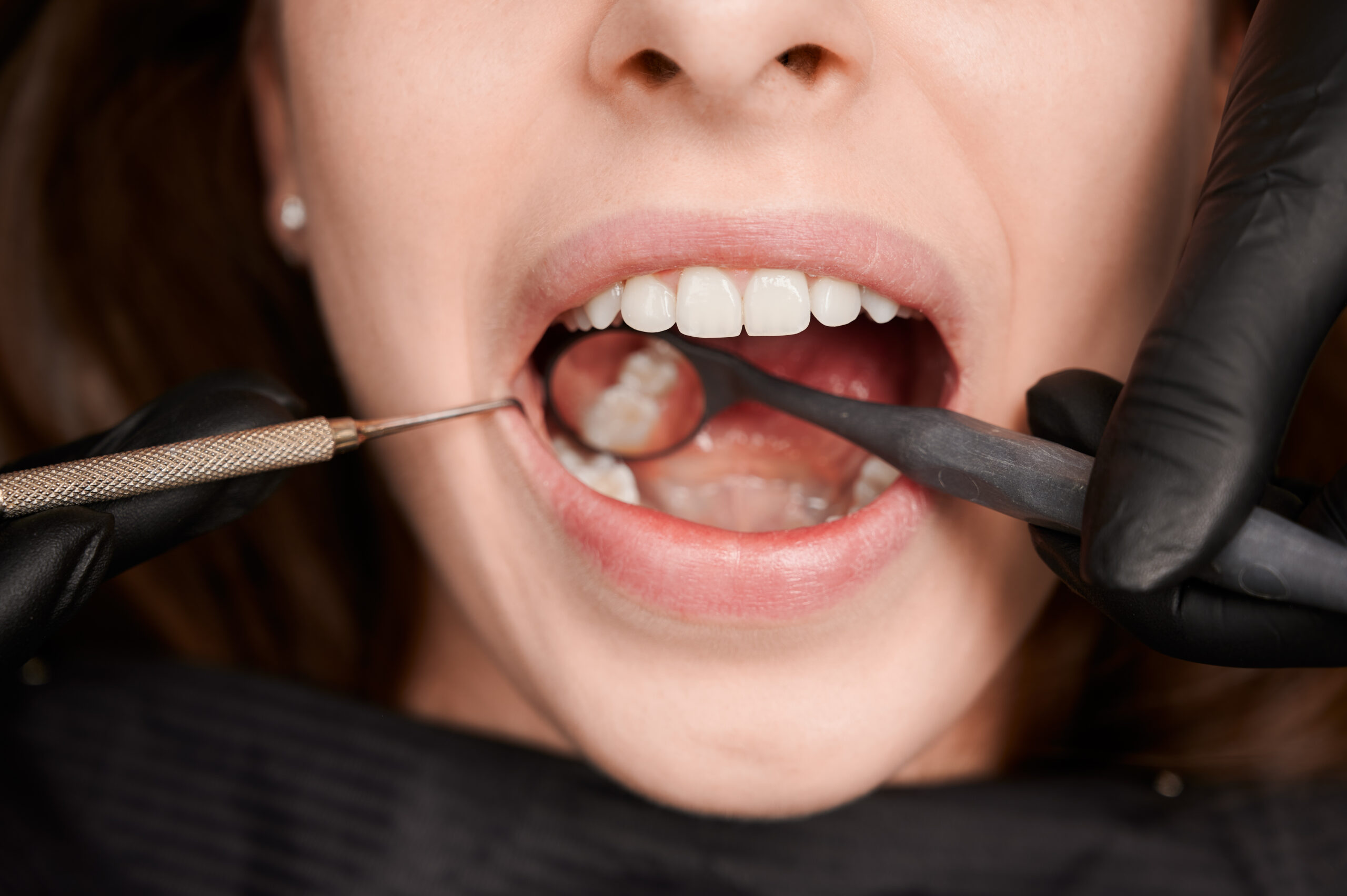 Dentist performing cavity filling on a patient's tooth Close-up of a tooth being treated with dental filling Dental procedure showing cavity removal and composite filling Tooth decay treatment with a white dental filling material Patient receiving painless cavity filling at dental clinic